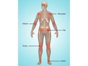 Joint Inflammation Illustration Poster Print By Gwen Shockeyscience Source (18 X 24)